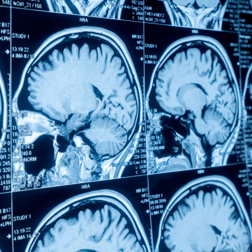 Chirurgie du crâne et du cerveau (traumatismes et tumeurs) Chirurgie du crâne et du cerveau (traumatismes et tumeurs)